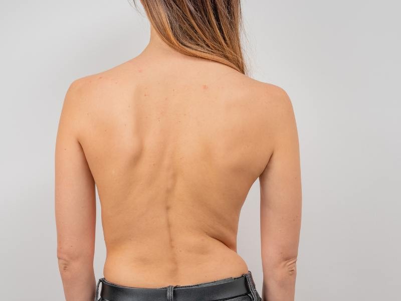 CIRURGIA DE ESCOLIOSE: CORRIGINDO A CURVATURA DA COLUNA